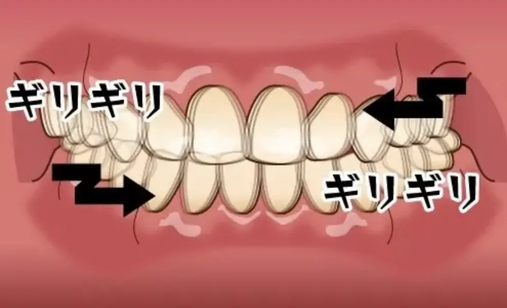 ギリギリと歯を横方向にすり合わせる歯の画像