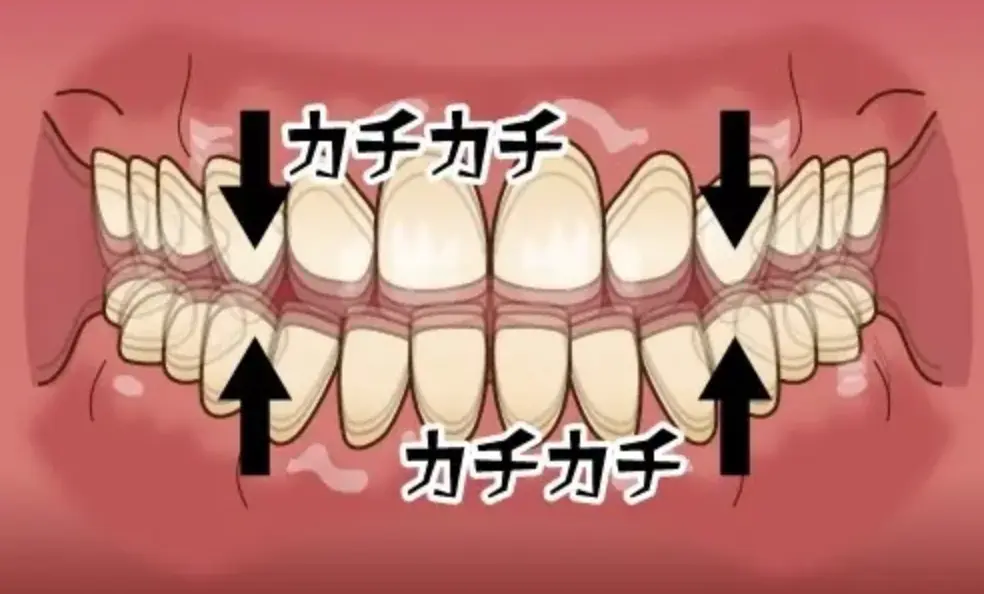 歯をカチカチと鳴らす歯の画像