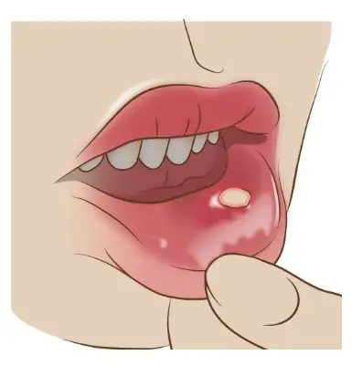 下唇の口内炎の画像