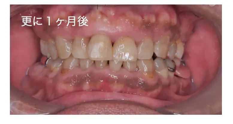西宮北口アネックスデンタルクリニック・矯正歯科に実際に来院された患者様の三ヶ月後の写真